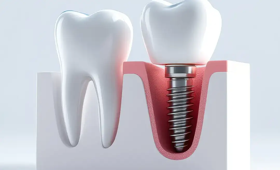 Implantes Dentários